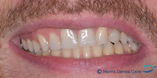 After the treatment which involved composite bonding and teeth whitening our patient's smile gave him more confidence.